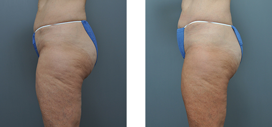 Two side-by-side views of a person's upper thigh and buttocks. The left image shows visible cellulite; the right image shows smoother skin.