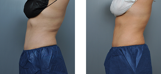 Side-by-side comparison of a person's torso. Left side: before. Right side: after, with a smoother, slimmer appearance.