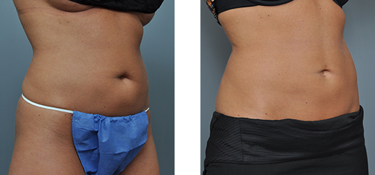 Before and after comparison of a person's abdomen, showing fat reduction.