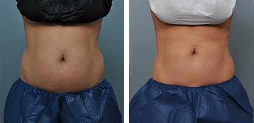 Two side-by-side images of a torso, pre- and post-treatment, showing a reduction in belly bulge.