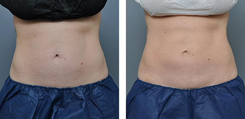 Comparison of a person's abdomen before and after a procedure.