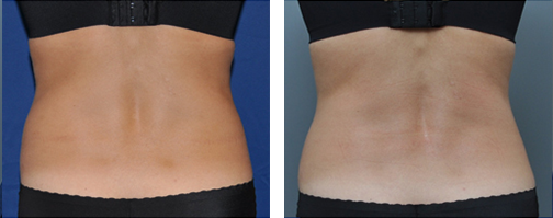 Comparison of a back before and after a medical procedure.