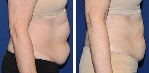 Side-by-side view of a person's abdomen before and after a procedure, showing a reduction in the abdomen's size.
