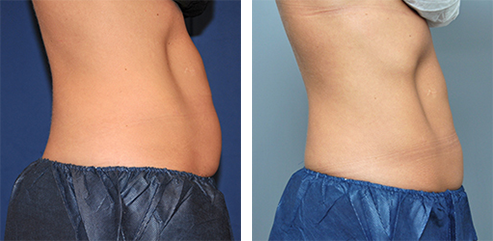 Side-by-side comparison of a person's abdomen, before and after a procedure. The 