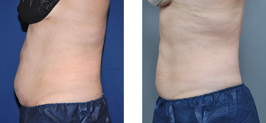 Two side-by-side photos of a person's abdomen, showing before and after body contouring results.