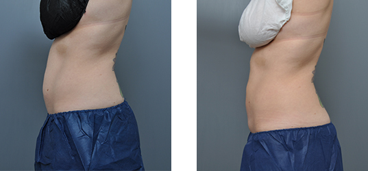 Two side-view photos of a torso before and after a body contouring procedure. Abdomen shape appears altered.