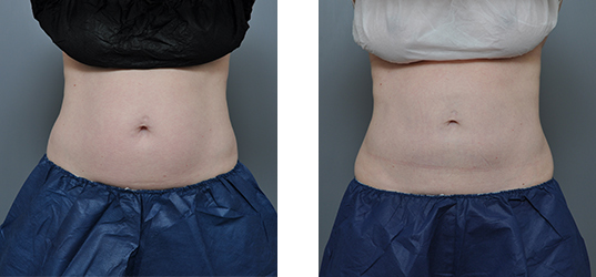 Two views of a person's abdomen, before and after a procedure. The before view shows some bulge. The after view appears flatter.