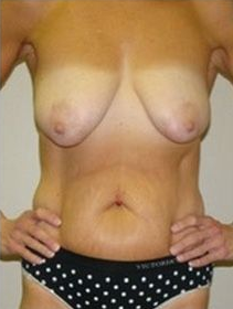 Torso of a person in underwear, showing breasts and abdomen. Hands on hips.