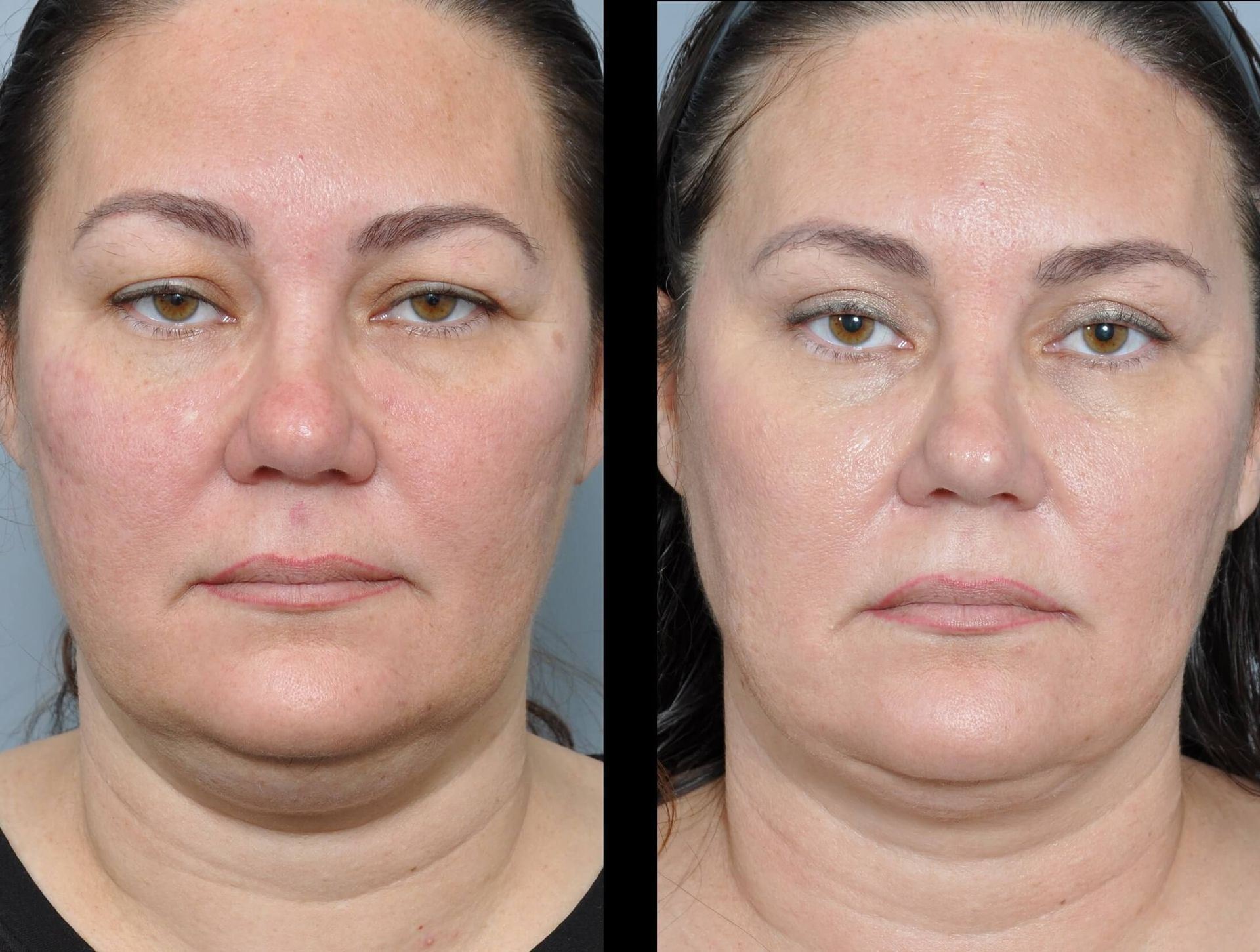 Before and after photo of a woman's face, showing smoother skin and reduced wrinkles after treatment.