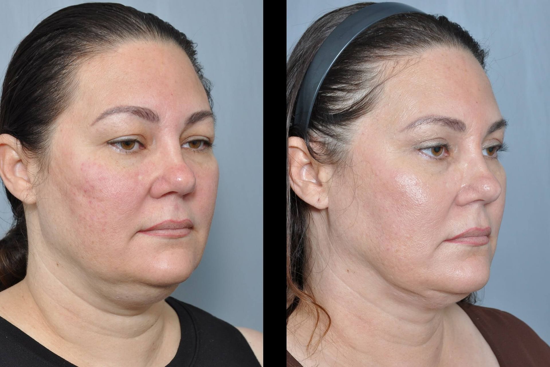 Before and after cosmetic surgery photos. Woman's face appears smoother, with less sagging.