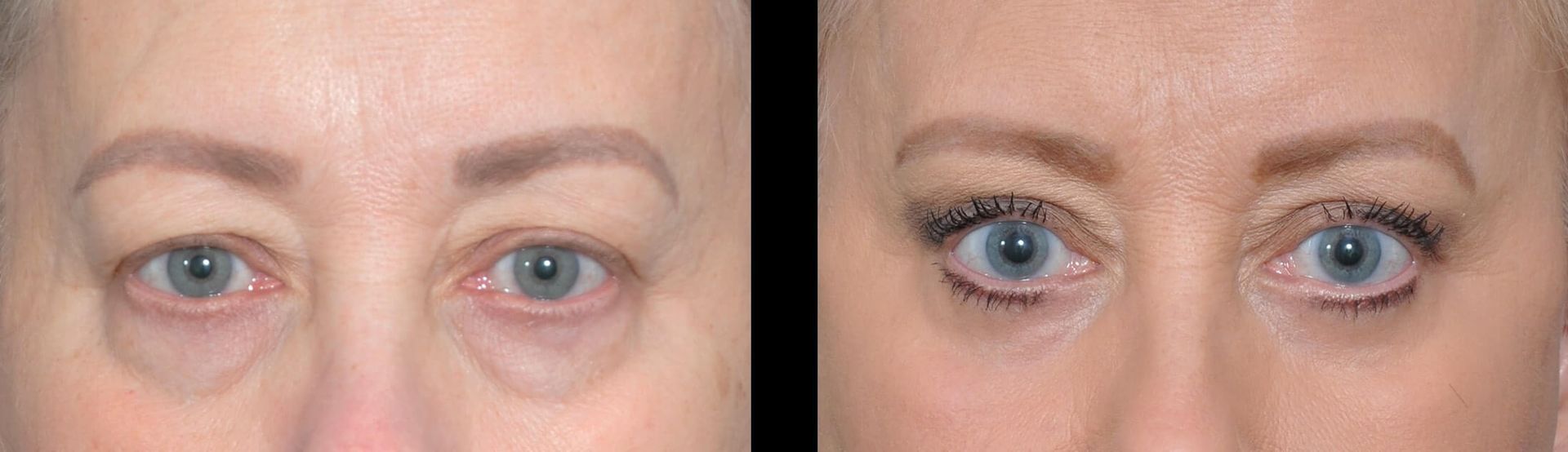 Before and after photos of a person's eyes, showing a reduction in eyelid sagging and under-eye bags.