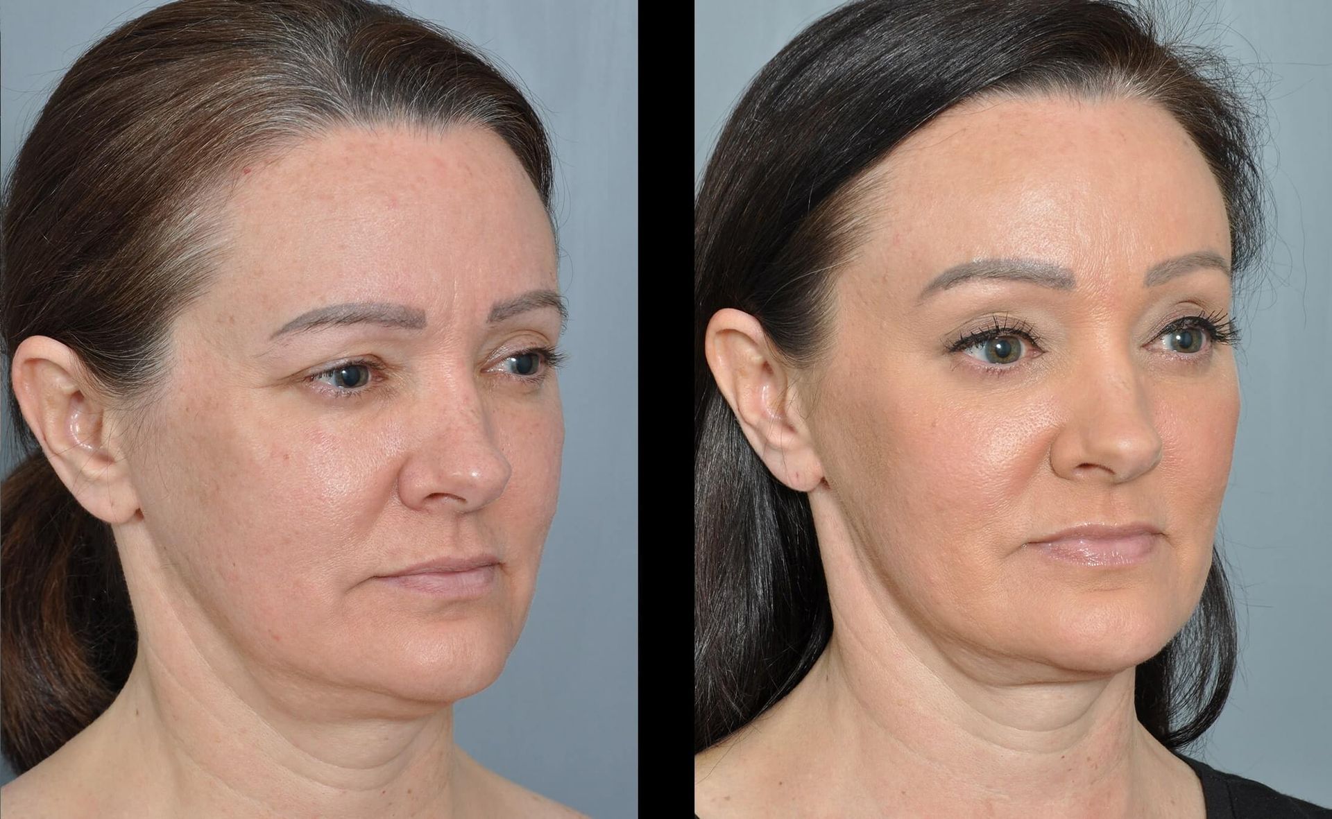Before-and-after facial rejuvenation comparison; skin appears tighter and smoother.
