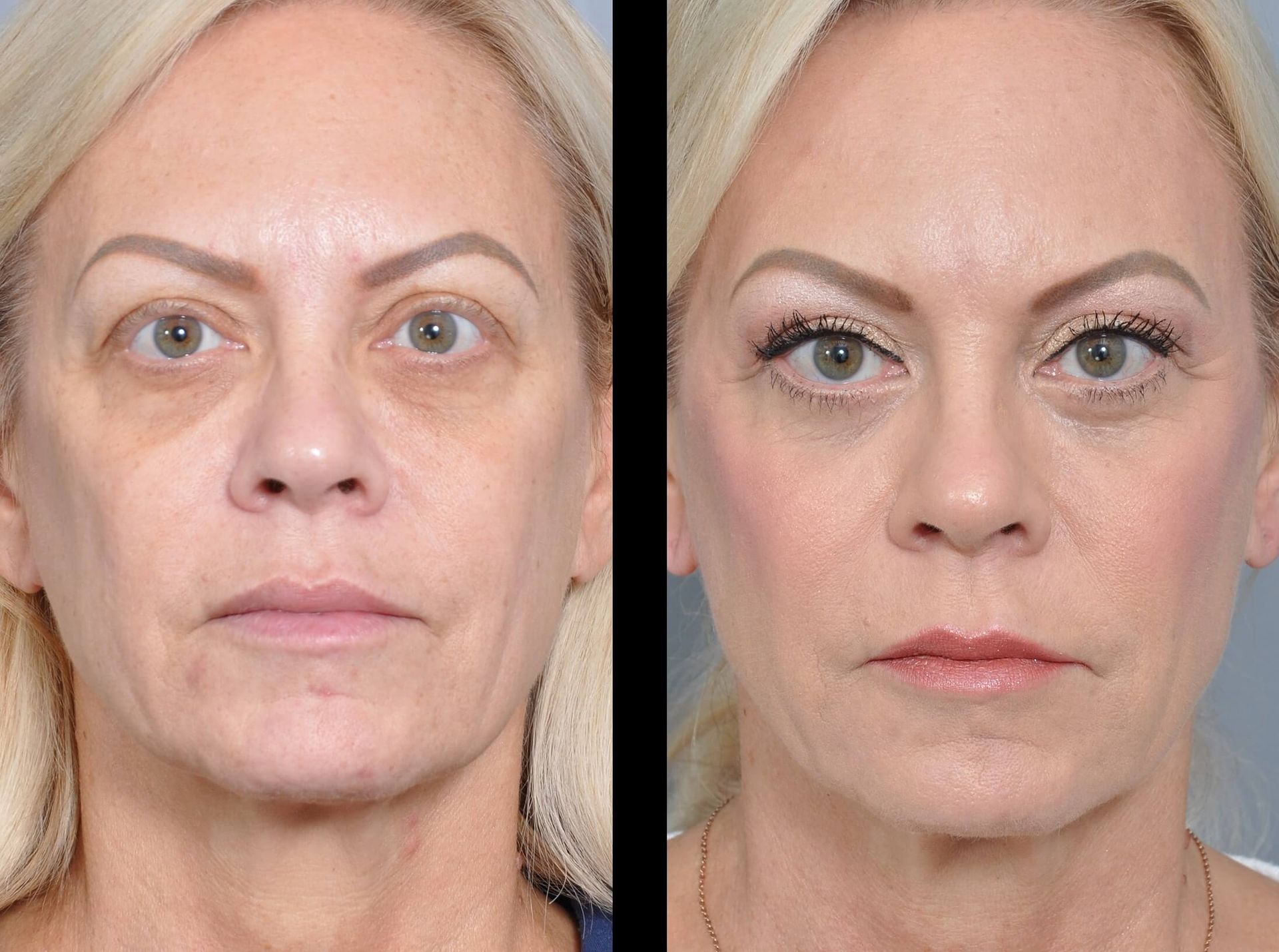 Before and after facial rejuvenation photos.