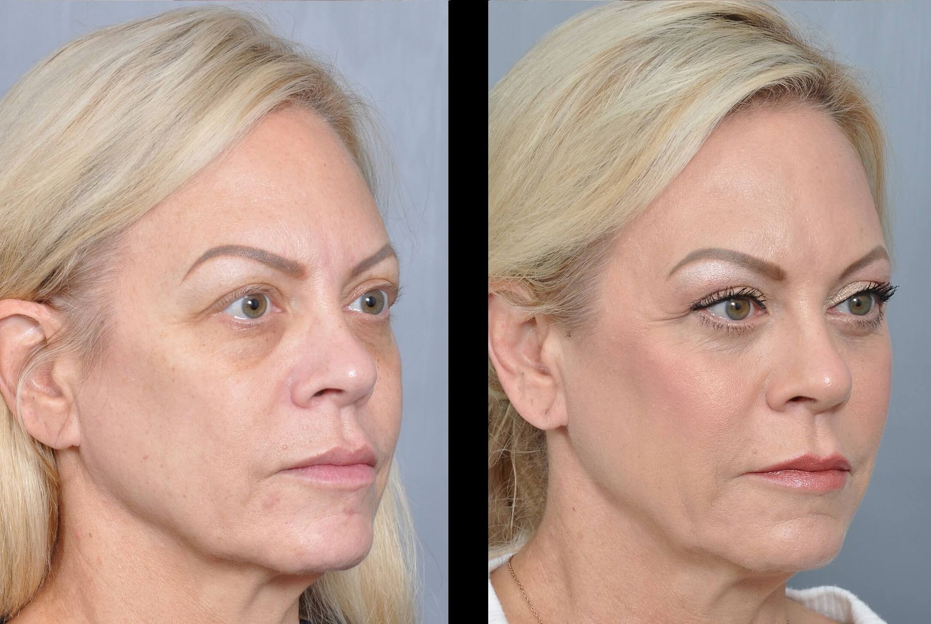 Before-and-after facial comparison. Woman's face shows reduced wrinkles, smoother skin, and a lifted appearance.