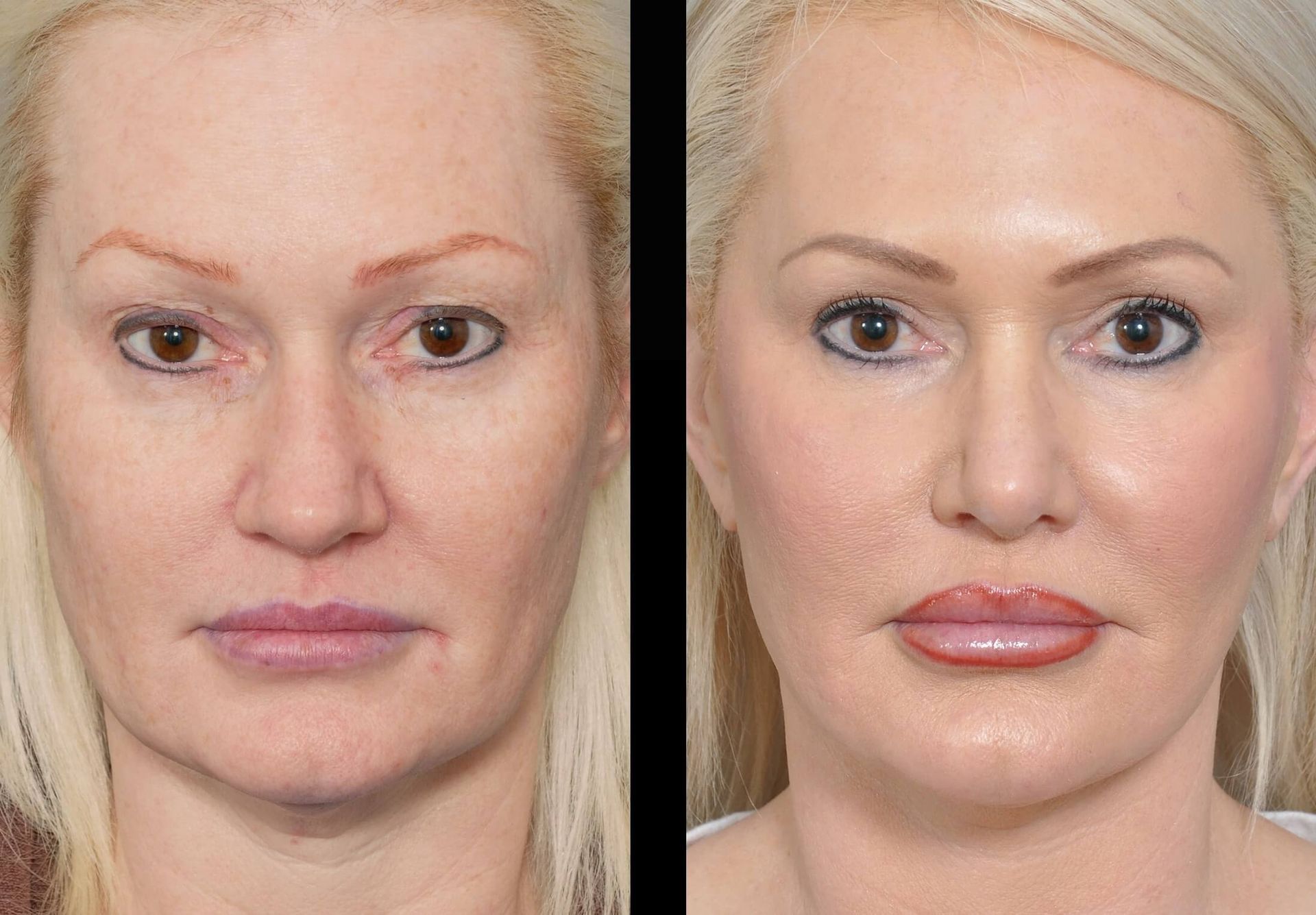 Side-by-side comparison of a person's face before and after cosmetic enhancements; skin appears smoother.