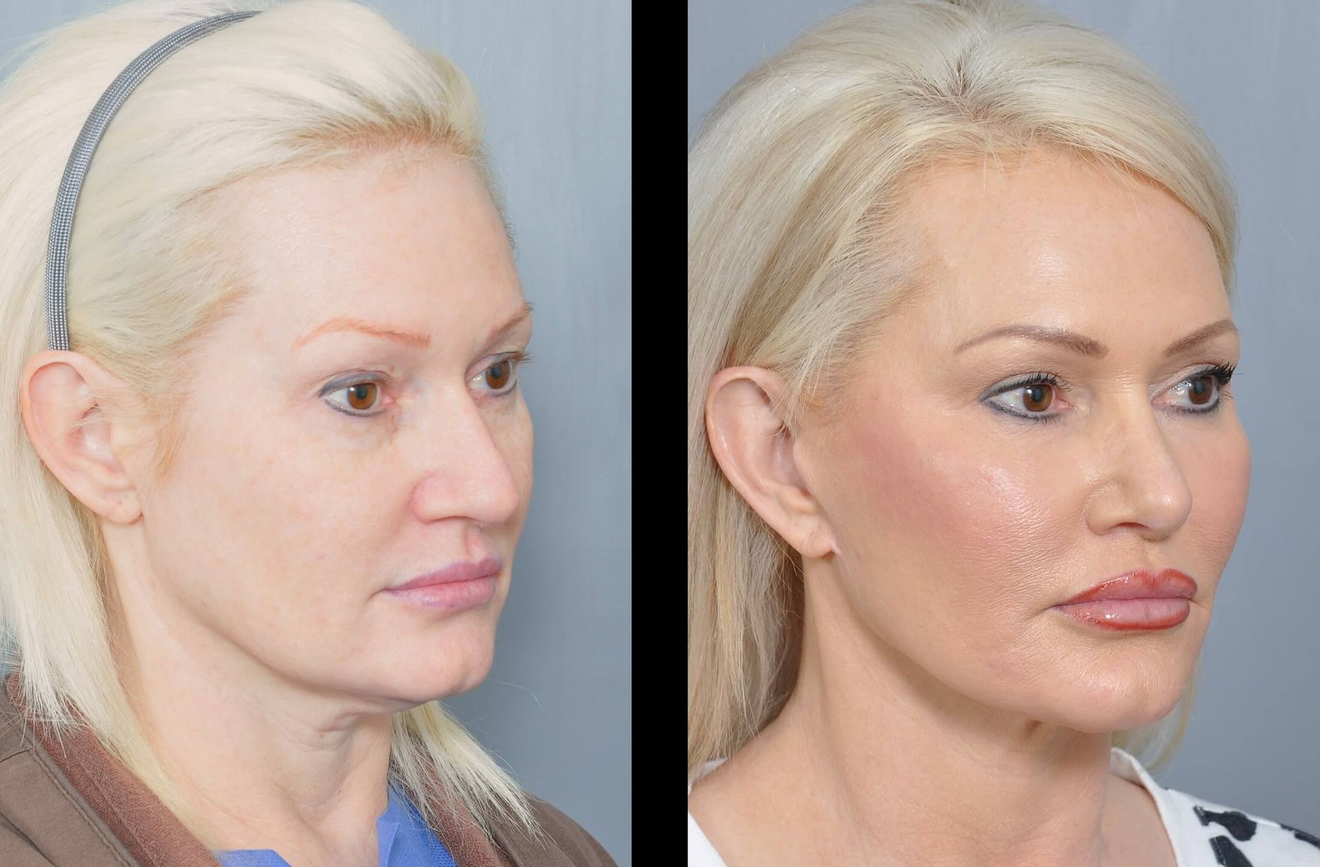Before and after photo of a woman's face, showing cosmetic surgery results. Skin appears smoother, with enhanced features.