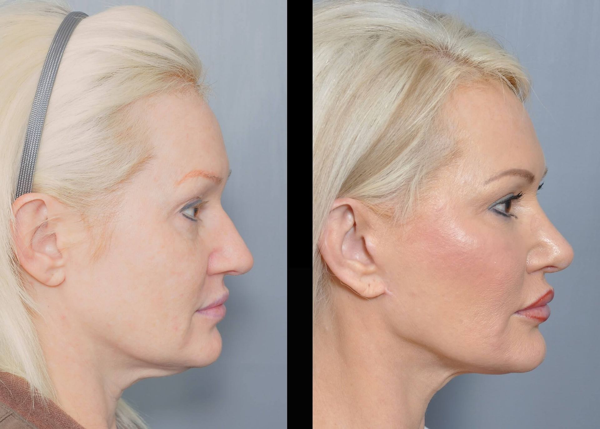 Before-and-after profile view of a woman's face. Left shows sagging skin; right, smoother skin after a procedure.