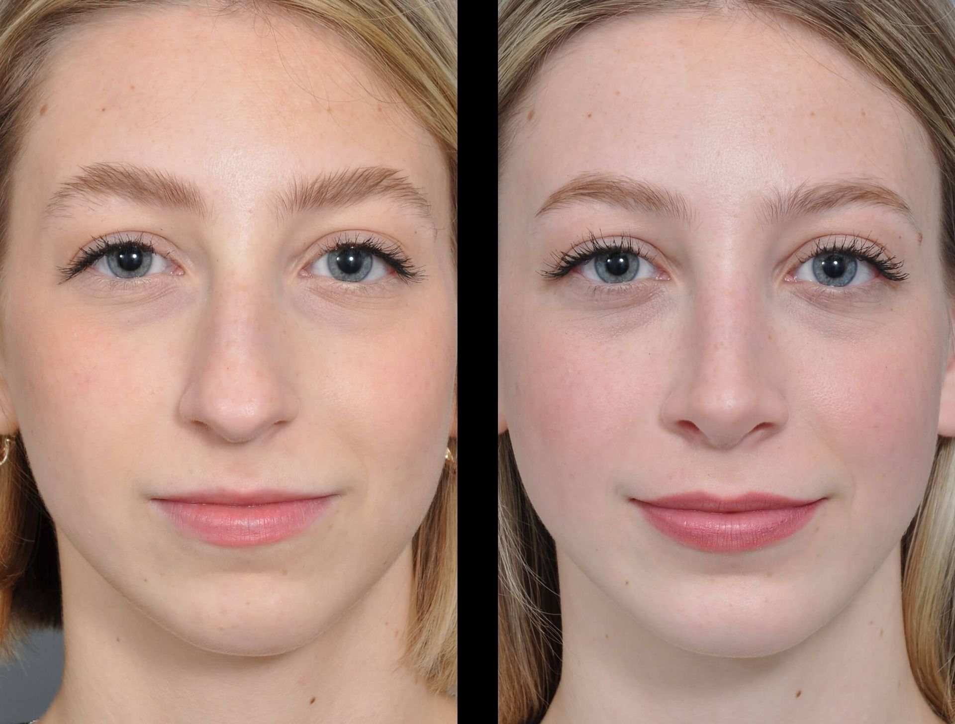 Side-by-side photos of a woman's face, before and after cosmetic work. The 