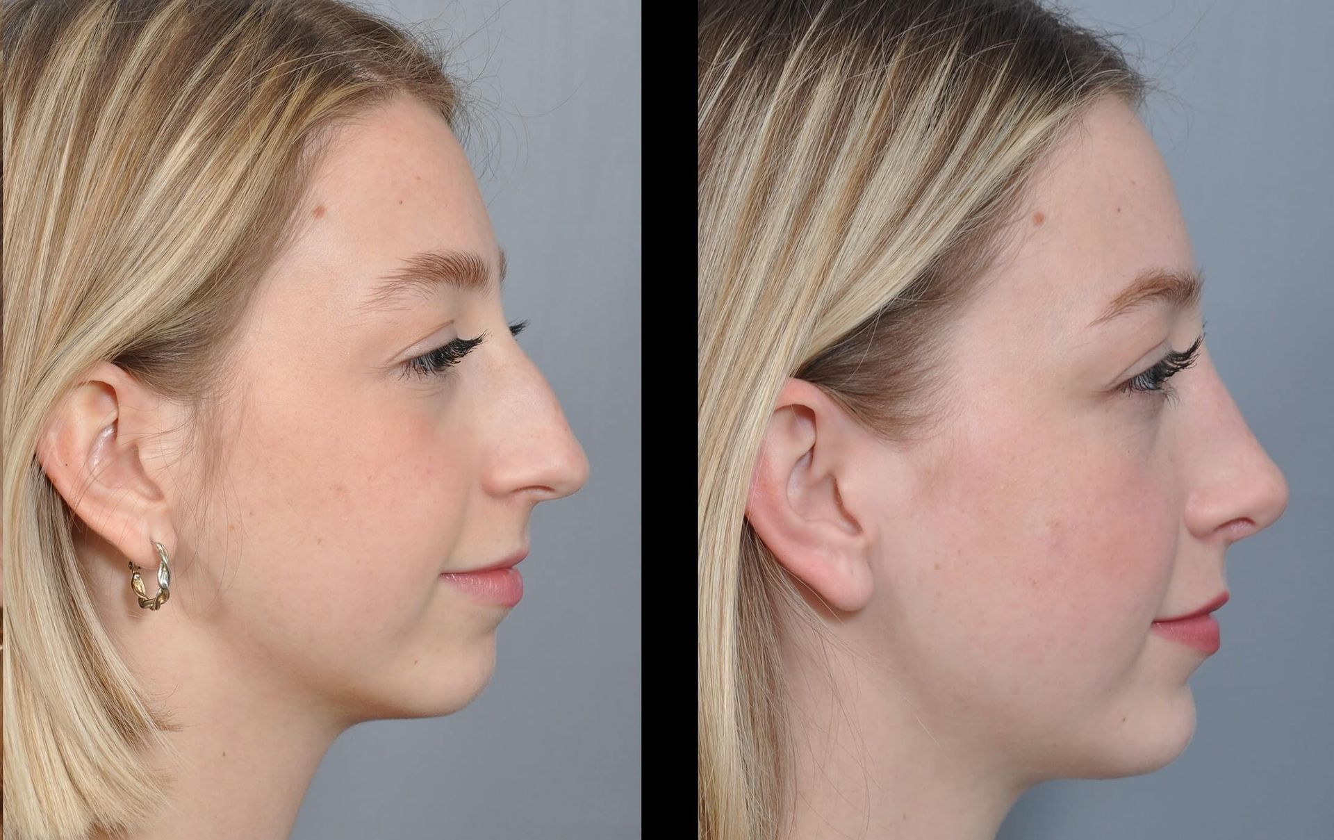 Before-and-after of woman's nose; the right has a straighter, smaller nose compared to the left.