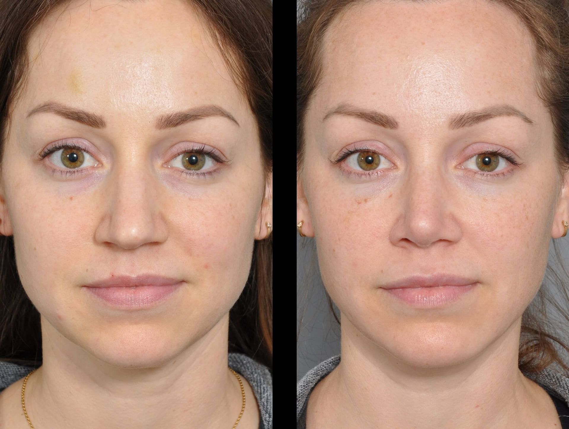 Before and after close-up of a face, showing skin improvement. Smoother texture and even tone after treatment.