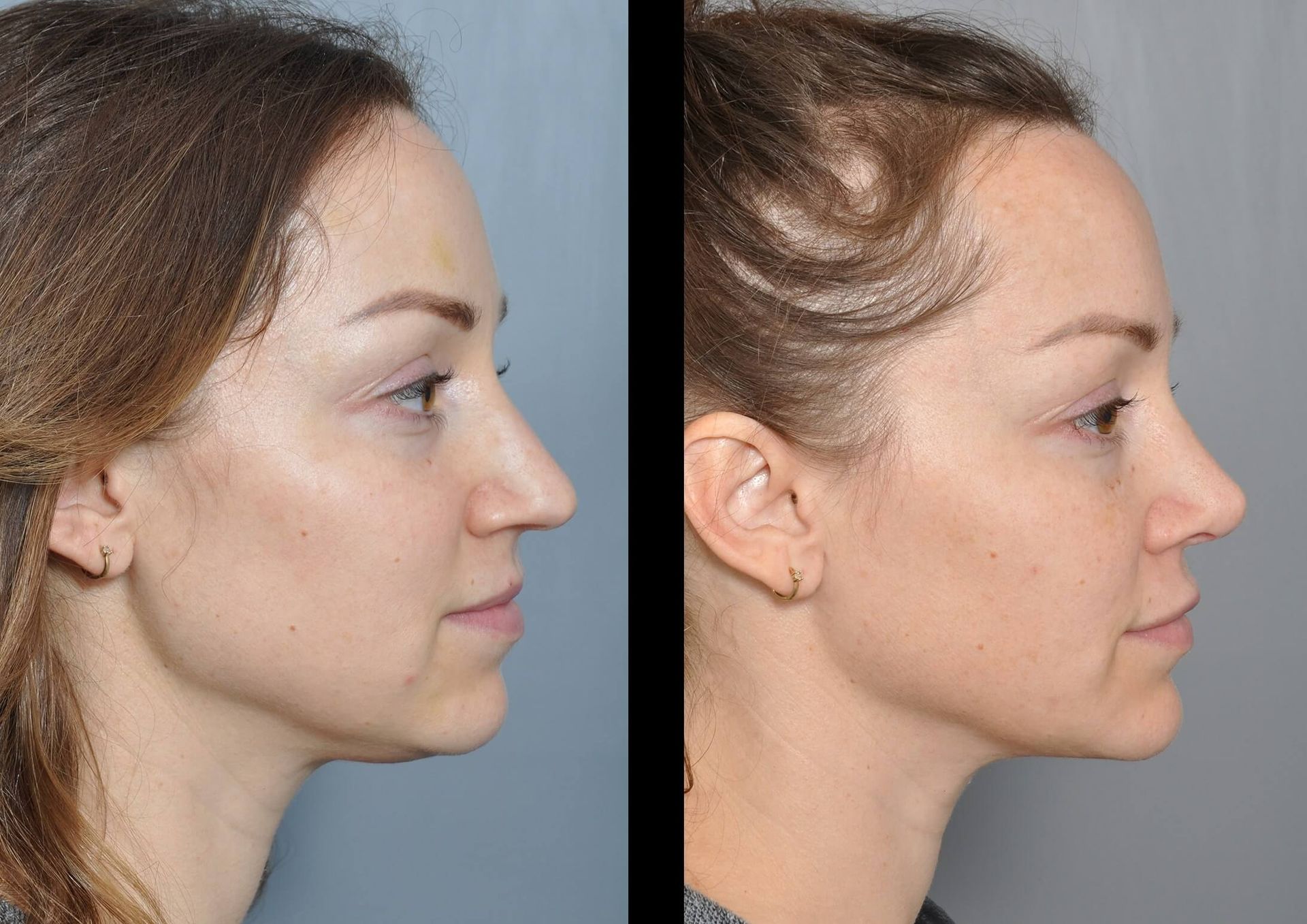 Side-by-side photos of a woman's profile before and after facial surgery, showing a change in nose shape.