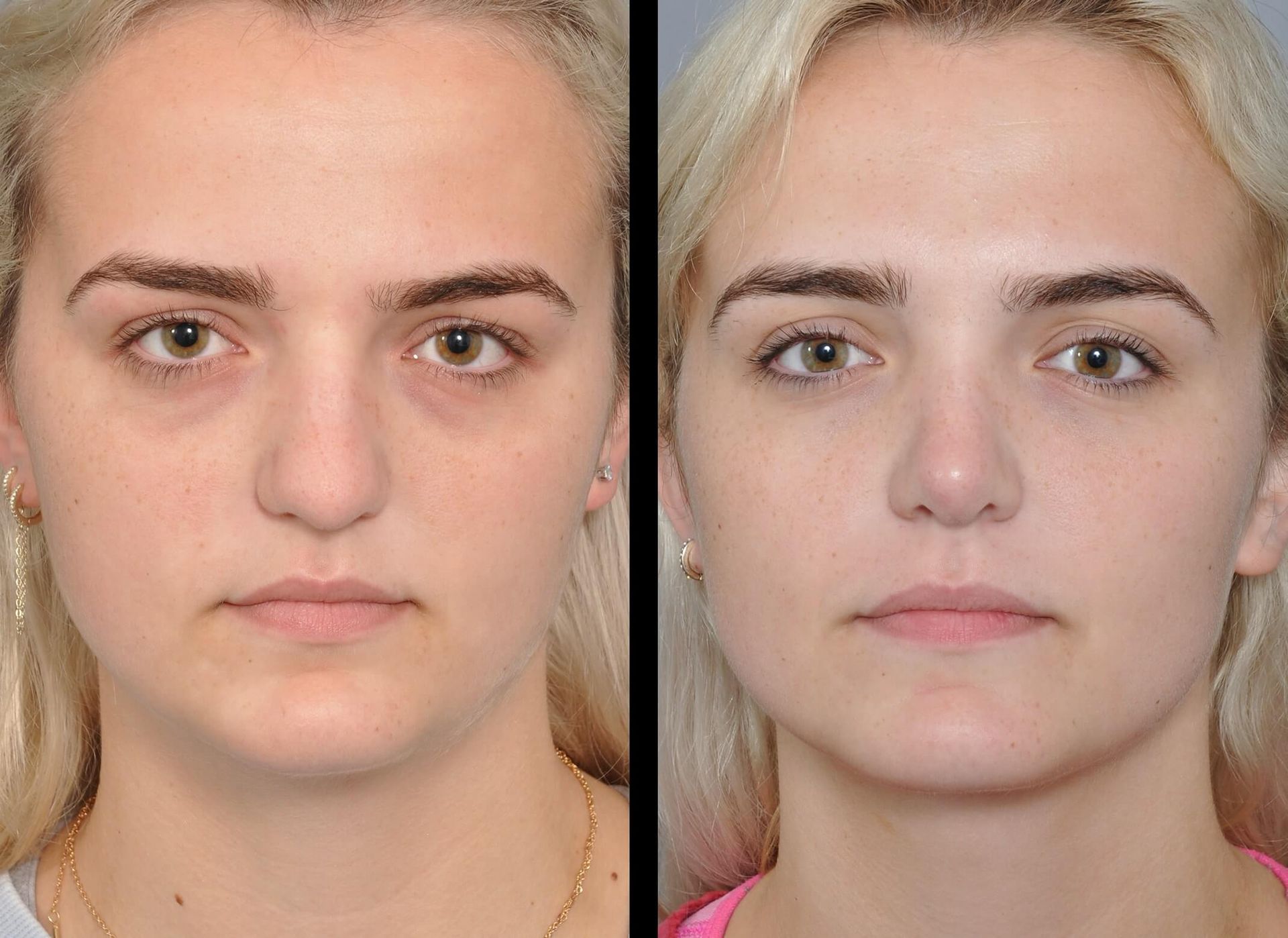 Before and after photos of a person's face; improved under-eye appearance and smoother skin.