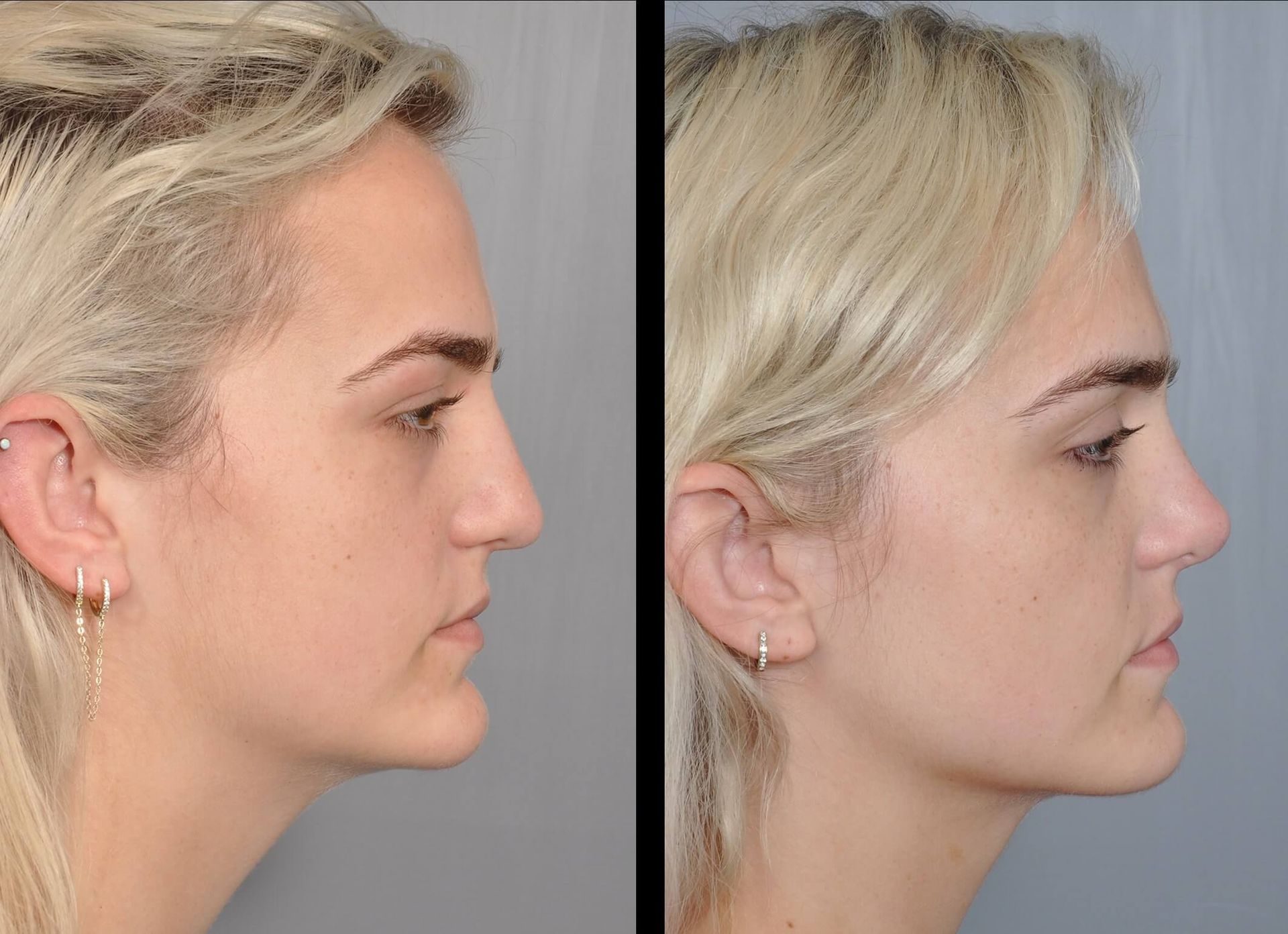 Before and after profile views of a person, showcasing rhinoplasty results, demonstrating a more refined nose shape.