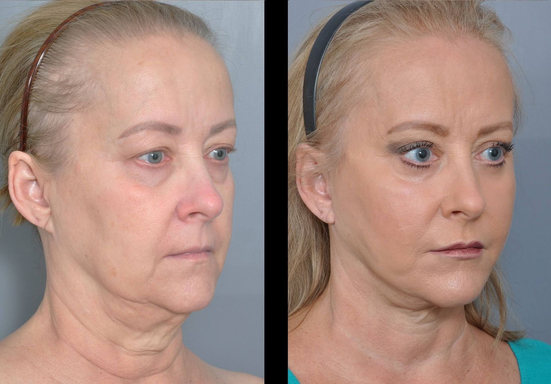 Before-and-after facial surgery comparison: woman, sagging skin, and then a tighter, lifted appearance.