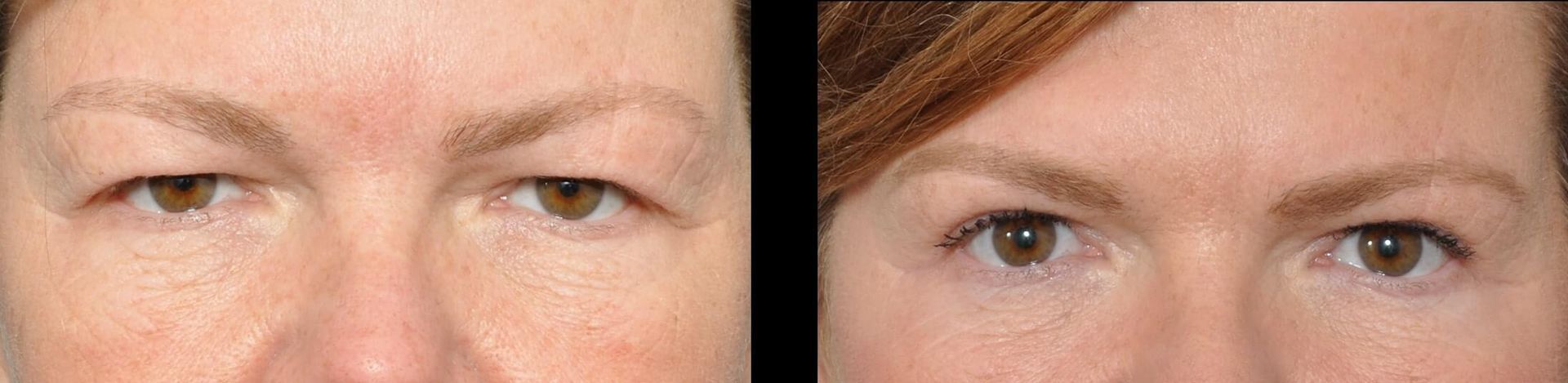 Before and after view of eyes, showing improvement after eyelid surgery.