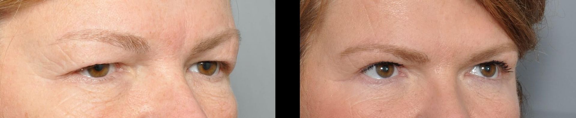Before and after of a person's eyes, showing a reduction in eyelid sagging.