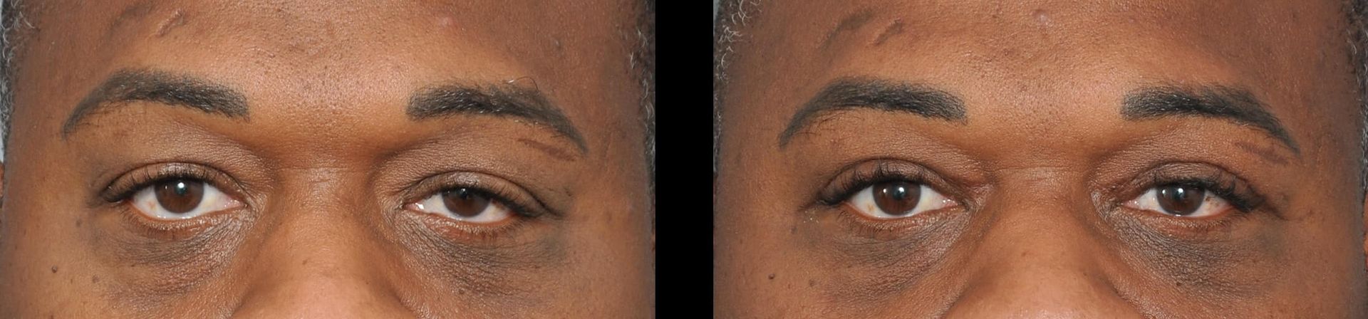 Two close-up views of eyes. Dark skin, dark eyebrows, dark shadows under eyes.