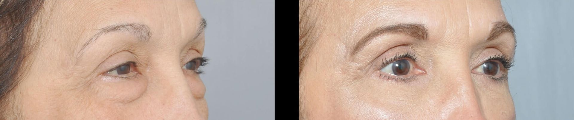 Comparison of eyes before and after an eyelid lift.