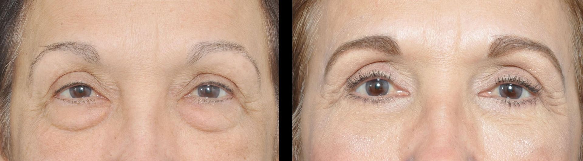 Comparison of eyes before and after eyebrow cosmetic procedure.