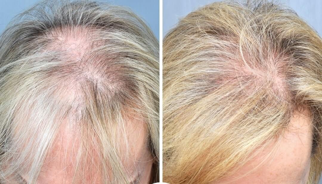 Before and after view of thinning hair on a scalp, showing improved hair density after treatment.