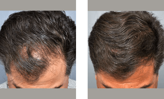 Before and after images of a person's scalp, showing hair loss reduction after treatment.
