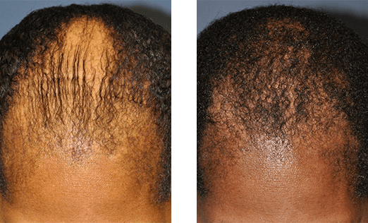 Hair loss comparison: Top of head shows thinning hair before and after treatment, scalp visible.