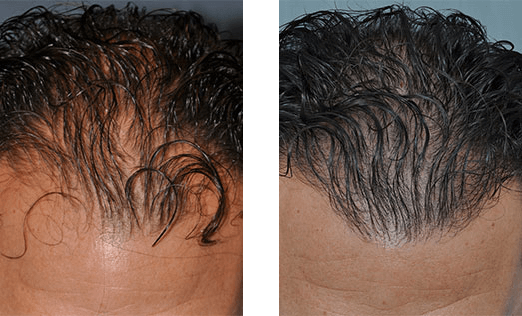 Before and after comparison of hair growth on a scalp. Sparse hair before, thicker hair after.