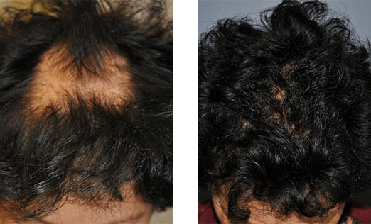 Before and after images of a person's head; hair loss is visible on the left, but is covered with new growth on the right.