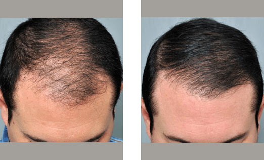 Before and after views of a man's hairline: thinning hair on the left, full hair growth on the right.