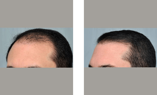 Before and after photos of a man's hairline: receding hairline on the left, full hairline on the right.