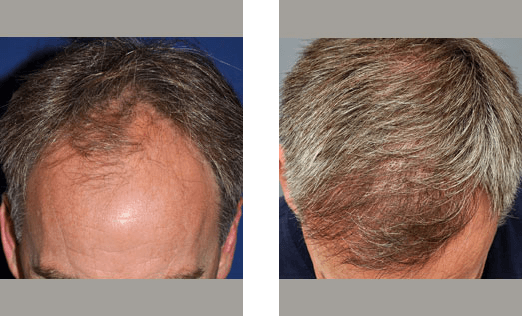Before and after hair transplant, showing receding hairline filled with new growth.