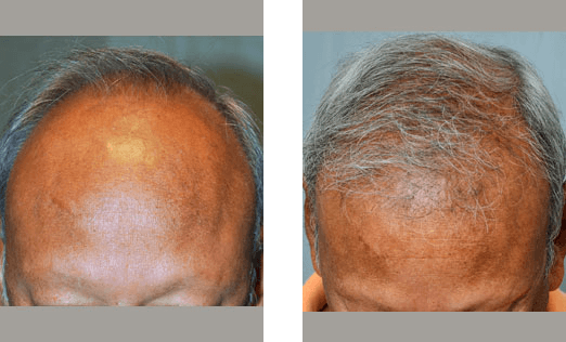 Before and after photos showing hair growth on a man's balding scalp.