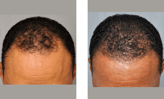 Before and after comparison of hair restoration; scalp visible, more hair on right side.
