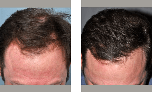 Before and after comparison of a receding hairline, showing hair growth following treatment.