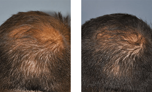 Two images of a person's head, showing hair growth. The left image has thinner hair with more scalp visible than the right image.