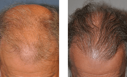 Before and after comparison of a man's scalp, showing hair loss at the crown, with increased hair growth.