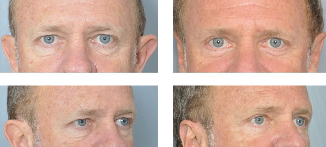 Before and after photos showing cosmetic ear surgery on a man.