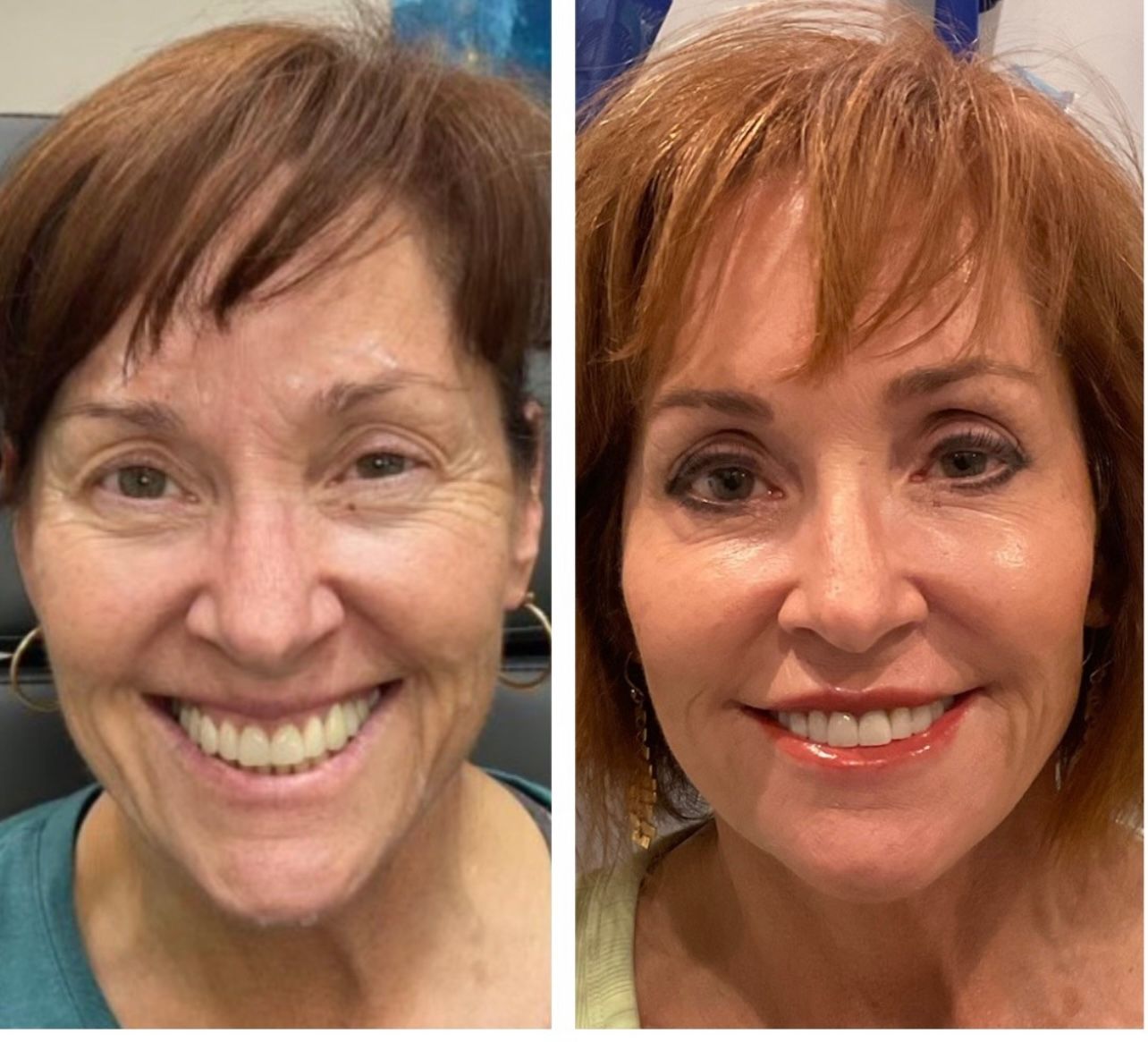 Side-by-side comparison of a person's face. Left side: with wrinkles. Right side: smoother skin, enhanced makeup.