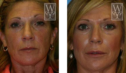 Before and after frontal view of a person's face after cosmetic procedure; smoother skin.