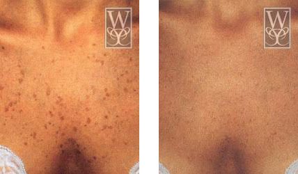 Before and after comparison of skin with and without brown spots.